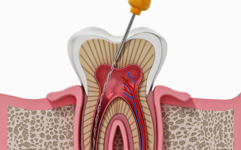 Root Canal Treatment (Endodontics)