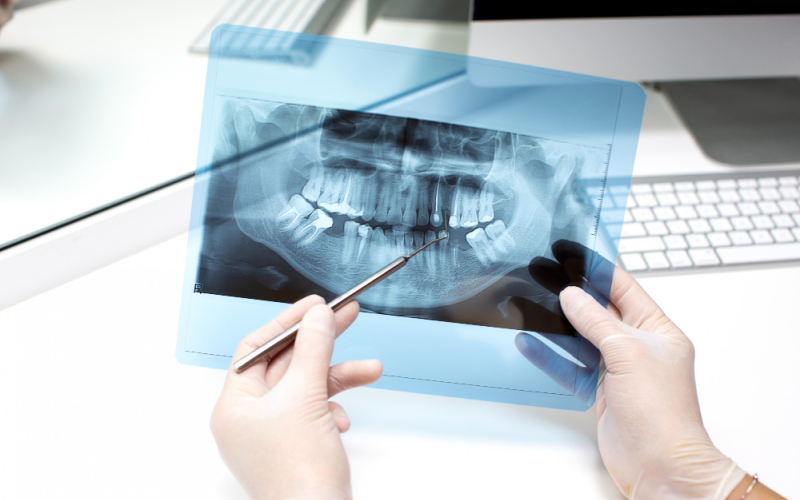 Permanent and Healthy Smiles with Implant Treatment