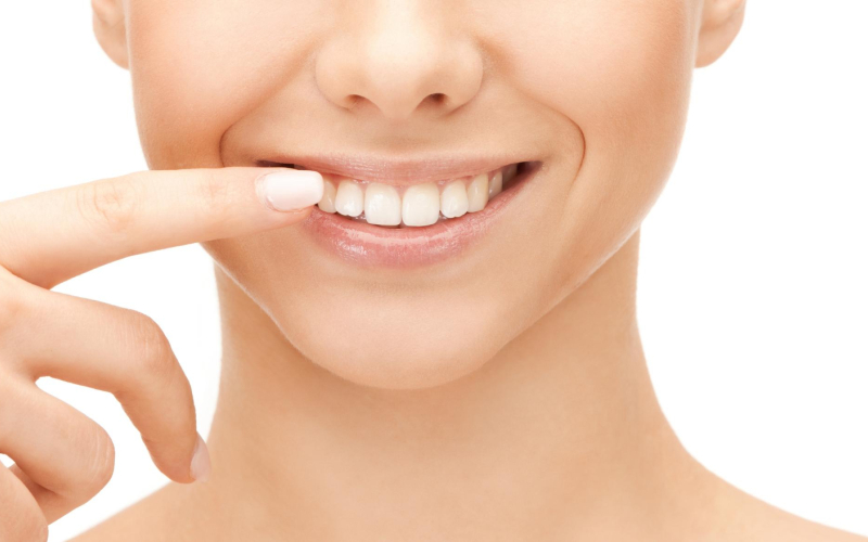 Teeth Whitening (Bleaching)